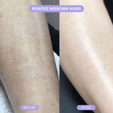 Discover a Faster, Gentler Way to Remove Unwanted Hair