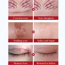 Scar Repair Cream